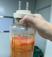 乐山水动力吸脂手术要做多久？